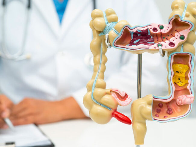 La dieta rica en lácteos ayuda a prevenir el cáncer de intestino