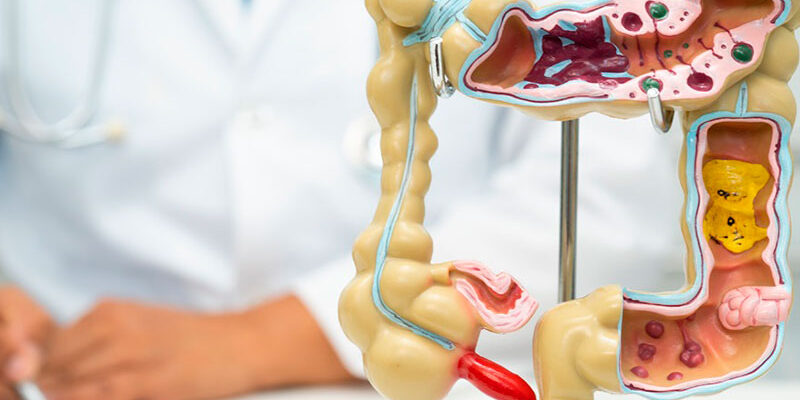 La dieta rica en lácteos ayuda a prevenir el cáncer de intestino